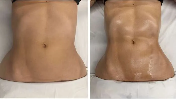 Antes e depois de drenagem linfática em Campo Grande – MS